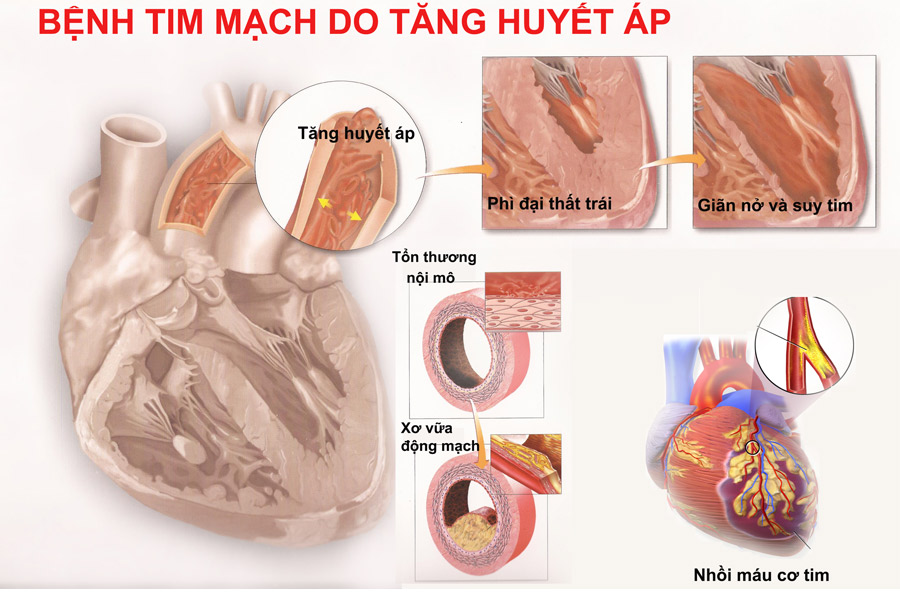  Các biến chứng tim mạch